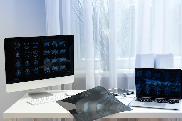des images d'IRM de la tête humaine sur un ordinateur portable et un écran d'ordinateur