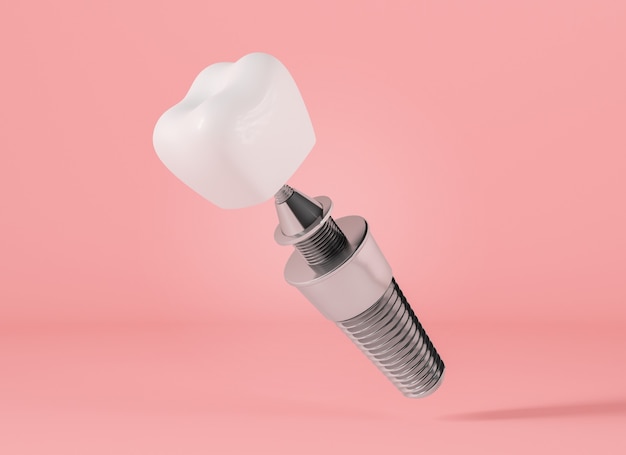 Implant dentaire sur fond rose, rendu 3d