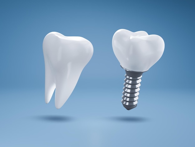 Implant dentaire réaliste et dent saine sur fond bleu 3d