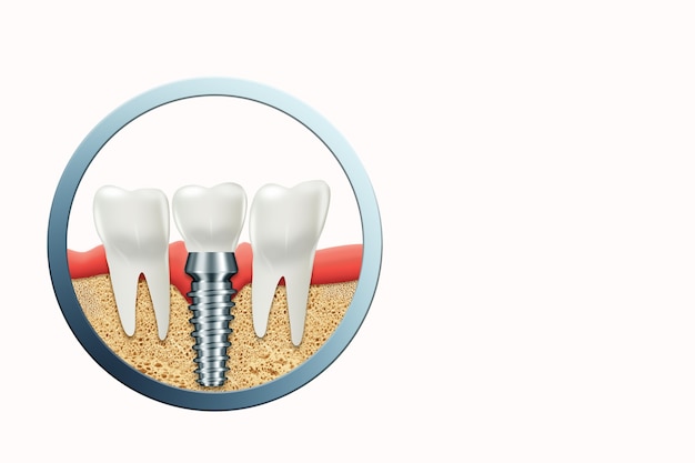 Photo implant dentaire, tenon gingival en acier inoxydable