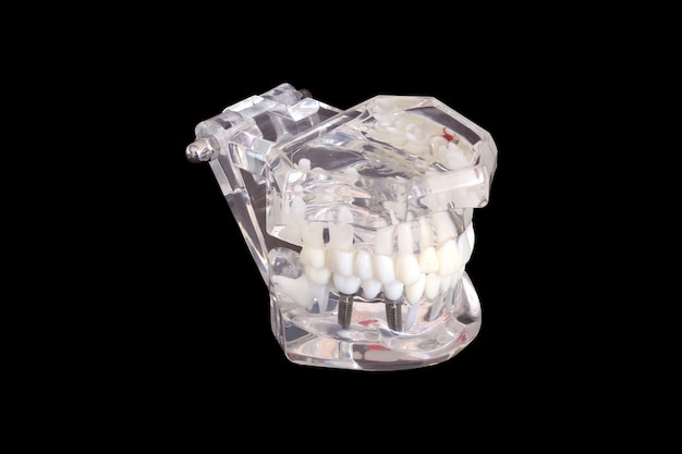 Implants dentaires isolés dans un moule d&#39;un modèle de mâchoire humaine sur fond noir avec un tracé de détourage