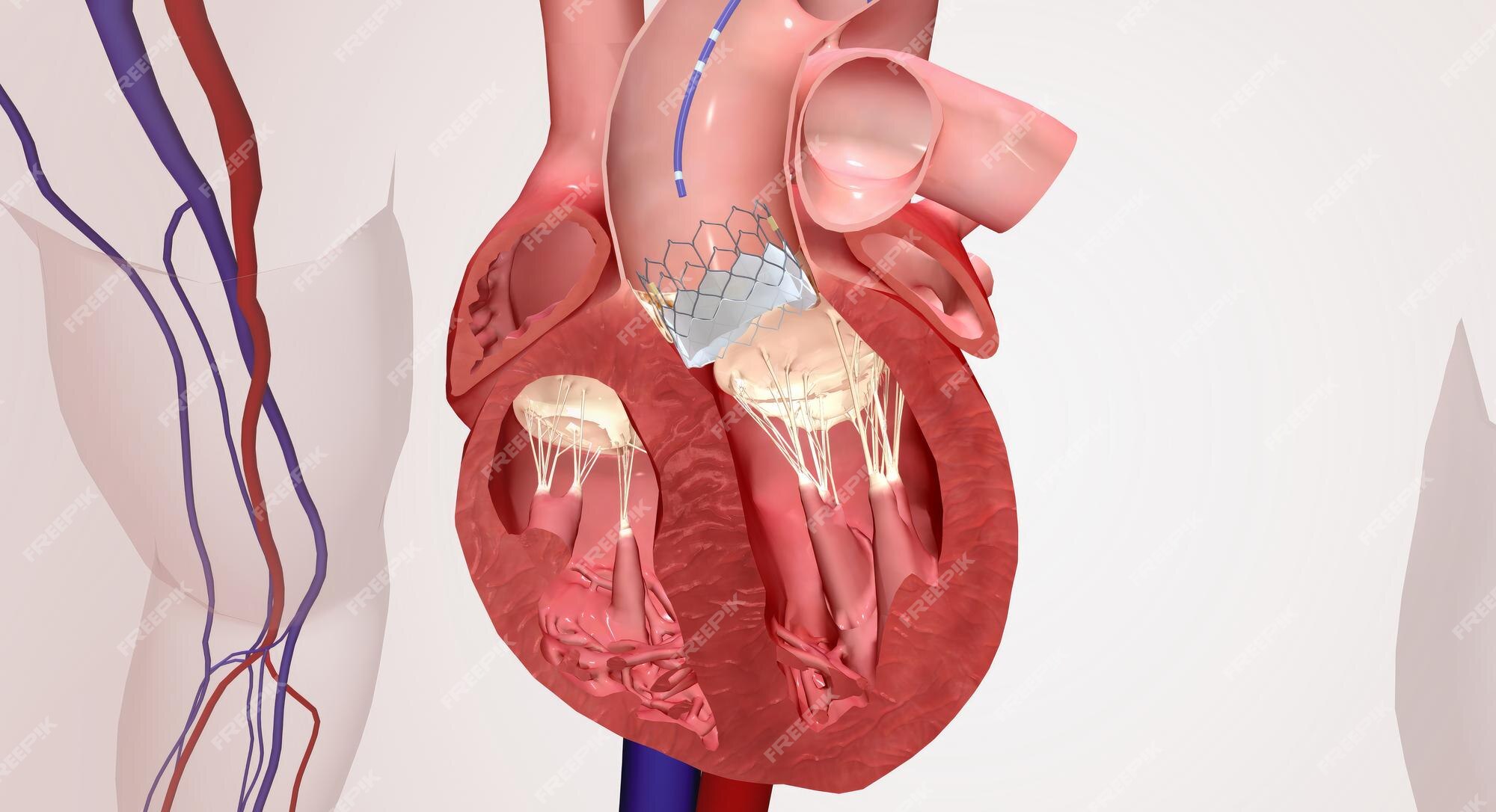 Insertion De Valve Dans Une Valve Cardiaque Endommagée