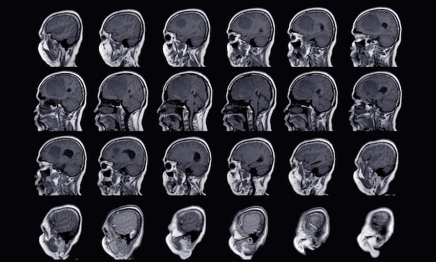 Photo irm cerveau découverte d'un méningiome résultant de la faux cérébrale antérieure s'étendant aux régions frontales bilatérales avec un œdème périlésionnel minimal adjacent au niveau des lobes frontaux gauches concept d'image médicale