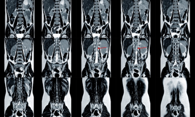 IRM du rachis montrant une masse apparaissant en hypersignal T2 et un fort rehaussement DDx épendymome myxopapillaire