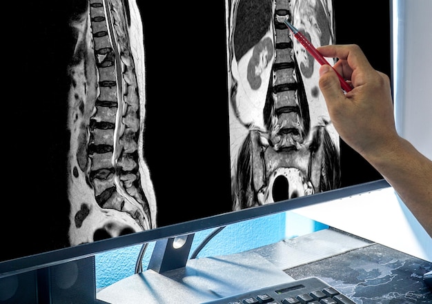 IRM de fracture compression du rachis lombaire Bombement de L1-2. sur le point du médecin, spondylose lombaire des disques L1-2 aux disques L5-S1.Concept de soins médicaux.