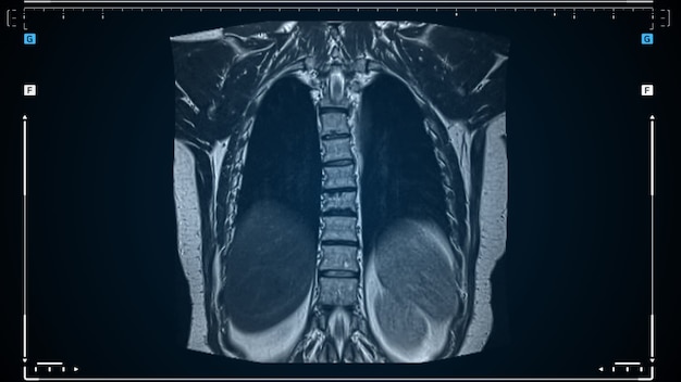 IRM pulmonaire, imagerie par résonance magnétique d'un gros plan du dos et du squelette. Diagnostic de maladie respiratoire virale ou covid-19. Animation tomodensitométrique des résultats.