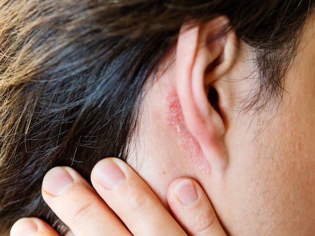 Photo irritation sur la peau derrière l'oreille. homme à la peau squameuse. allergie ou maladie fongique.