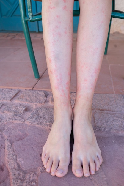 Photo des jambes de filles mordues par des moustiques en gros plan une femme se grattant les pieds mordues d'insectes