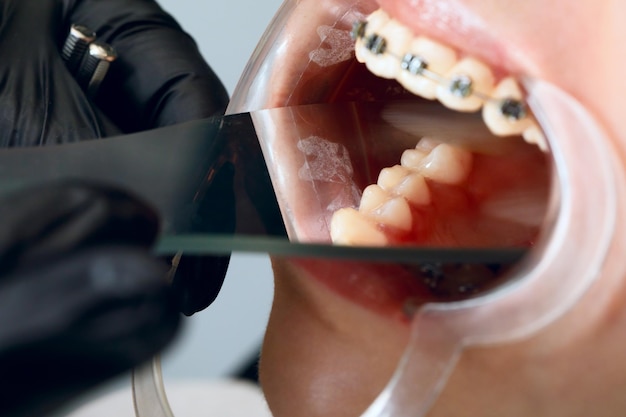 Une jeune femme avec des accolades en métal est examinée par un orthodontiste correction de la morsure des dents