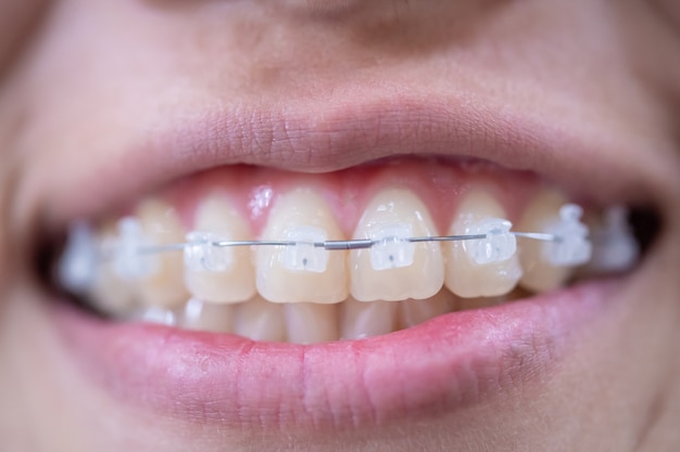 Jeune femme bouche souriante avec des bretelles blanches et des dents saines