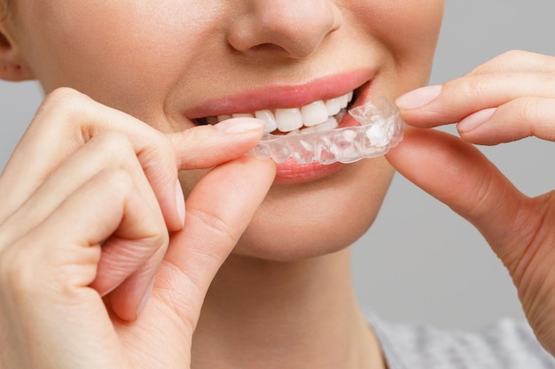 Une jeune femme fait une procédure de blanchiment des dents à la maison en blanchissant le plateau avec du gel