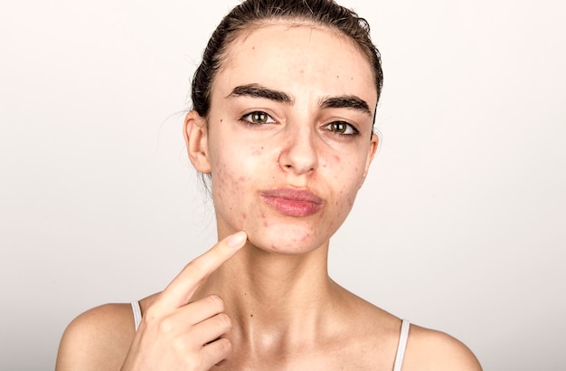 Photo jeune femme à la peau problématique