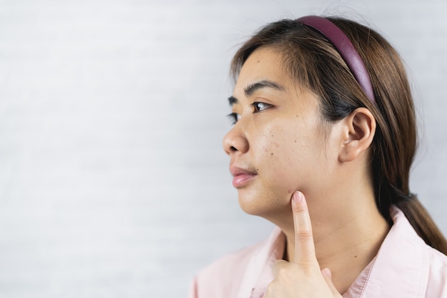 Jeune femme avec problème d'acné sur fond gris