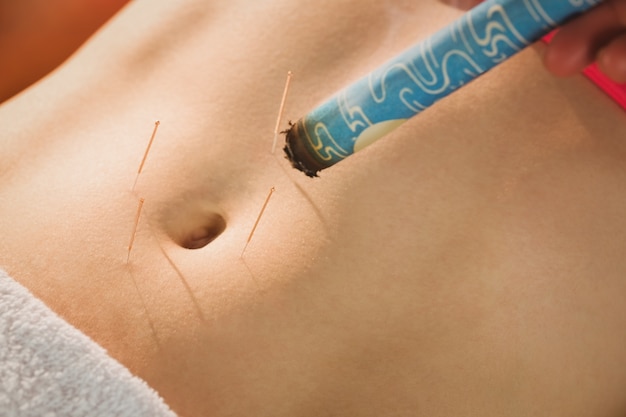Jeune femme recevant un traitement d&#39;acupuncture