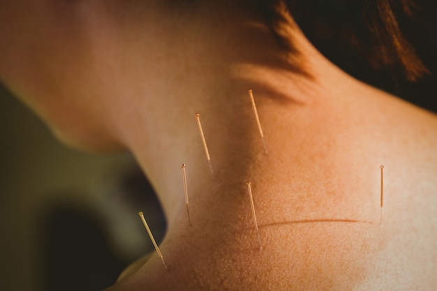 Jeune femme recevant un traitement d&#39;acupuncture