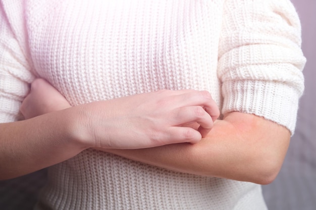 Photo la jeune femme se gratte les mains à cause des démangeaisons. dermatite allergique. maladie de la peau vitiligo. maladie de névrodermite, eczéma ou éruption cutanée allergique à la laine. santé et médical..