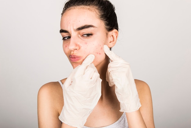 Jeune femme souffrant d'acné sur la peau du visage