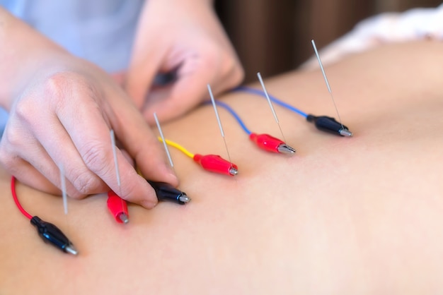 Photo jeune femme subissant un traitement d'acupuncture au spa santé