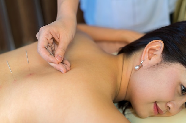 jeune femme subissant un traitement d&#39;acupuncture au spa santé