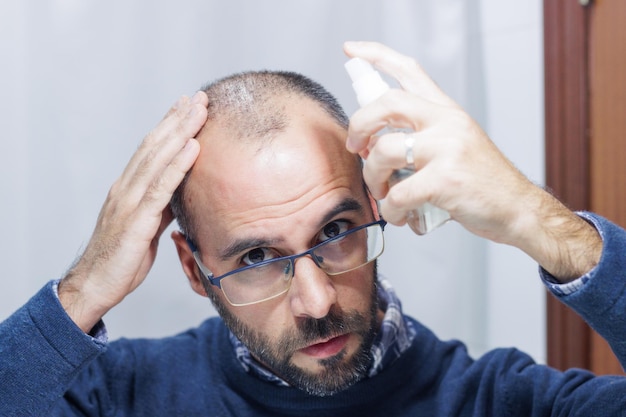 Jeune homme avec alopécie regardant sa tête et ses cheveux dans le miroir et appliquant un médicament en spray à la maison