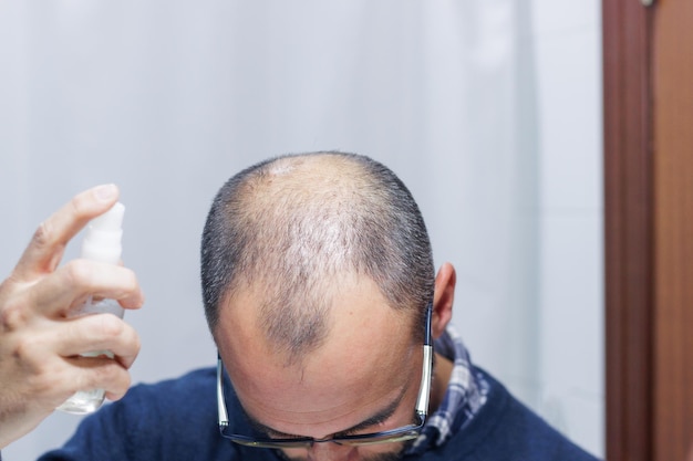 Jeune homme avec alopécie regardant sa tête et ses cheveux dans le miroir et appliquant un médicament en spray à la maison