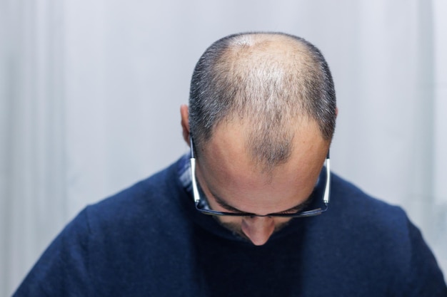 Jeune homme avec alopécie regardant sa tête et ses cheveux dans le miroir