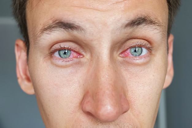 Jeune homme aux yeux rouges