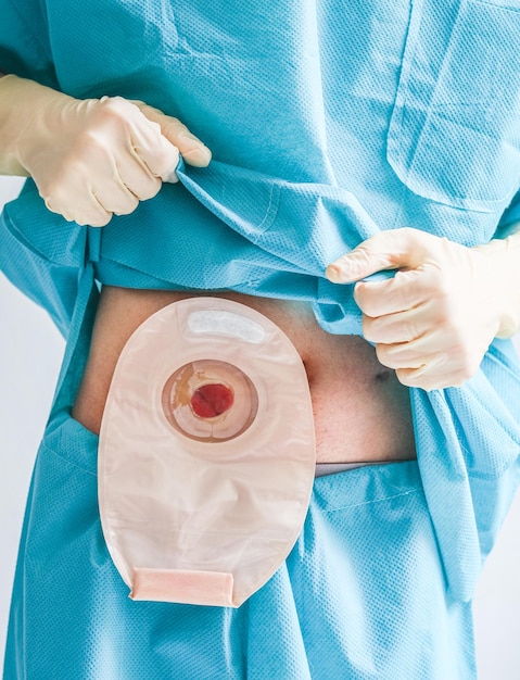 Jeune patient de race blanche en pyjama médical jetable bleu montre un sac de colostomie sur le ventre