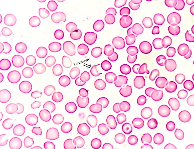 Photo kératocyte cellule de corne rbc fragmenté un type de schistocyte qui indique généralement une maladie