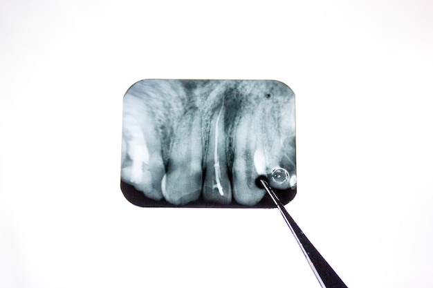 Kyste Radiographie de la dent Kyste radiculaire de la mâchoire supérieure Formation pathologique une tumeur dans la dent est visible sur la radiographie Radiographie des dents d'une personne atteinte d'une infection un abcès une dent cassée