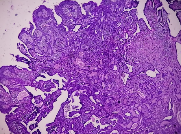 Lame histologique sous microscopie montrant un papillome épidermoïde pédiculé