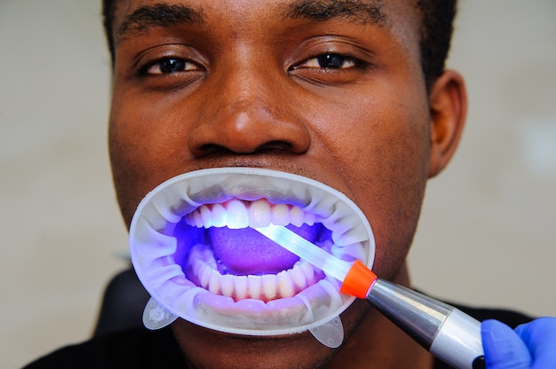 Lampe à ultraviolets remplissant les dents