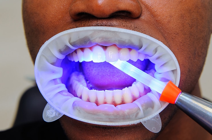 Photo lampe à ultraviolets remplissant les dents