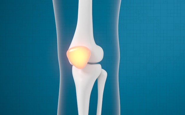 Lésions de l'os de la jambe et du genou rendu 3D dessin numérique par ordinateur