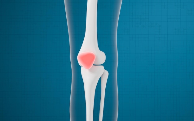 Lésions d'os de jambe et de genou rendu 3d