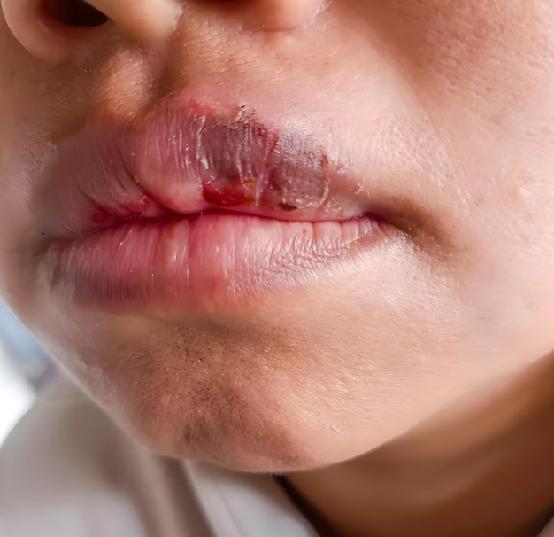 Photo lèvre sèche fissurée et déshydratée d'un patient asiatique