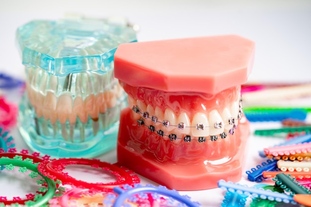 Ligatures Orthodontiques Anneaux Et Liens Bandes De Caoutchouc élastiques  Sur Les Appareils Orthodontiques Modèle Pour Le Dentiste étudiant La  Dentisterie