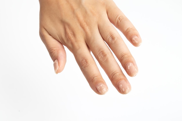 Liquide pour l'enlèvement à domicile du vernis à ongles en gel en action sur la main d'une femme