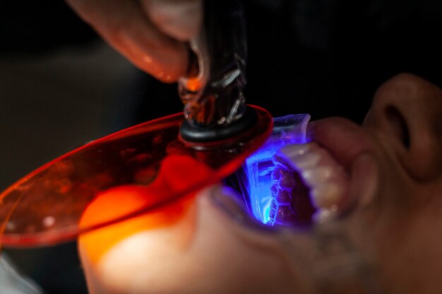 Lumière ultraviolette pendant la procédure dentaire