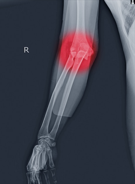 Luxations et fractures du coude aux rayons X.