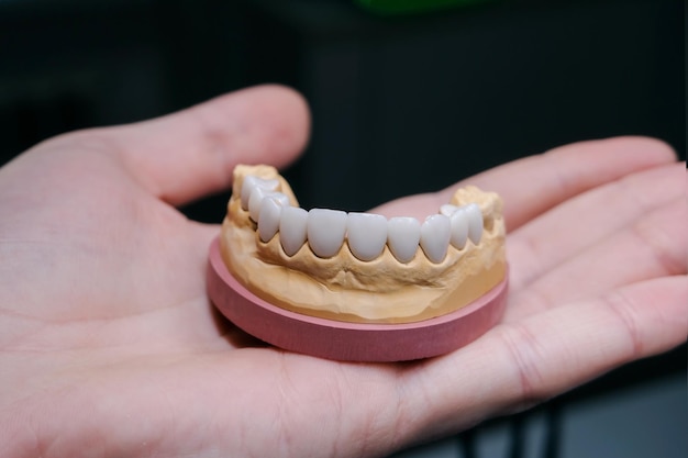 Une mâchoire avec des dents en céramique Dentist39s appareil dans la main Gros plan