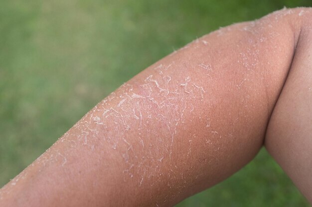 Photo main coupée d'une personne à la peau sèche