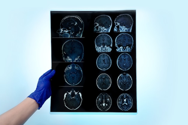 Main dans la main tenant l'IRM cérébrale ou les résultats de l'image par résonance magnétique, concept de neurologie, le médecin analyse l'instantané sur fond bleu