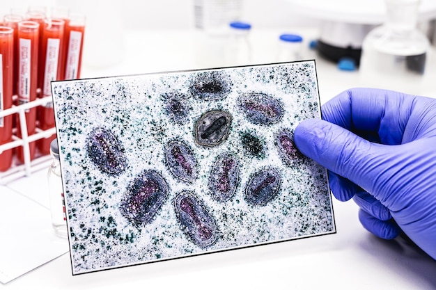 Photo la main du pharmacien avec un gant en latex tenant le vaccin contre la variole du singe avec une photo du virus de la variole en arrière-plan