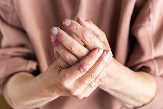 Mains de femme atteintes de dermatite atopique eczéma réaction allergique sur la peau