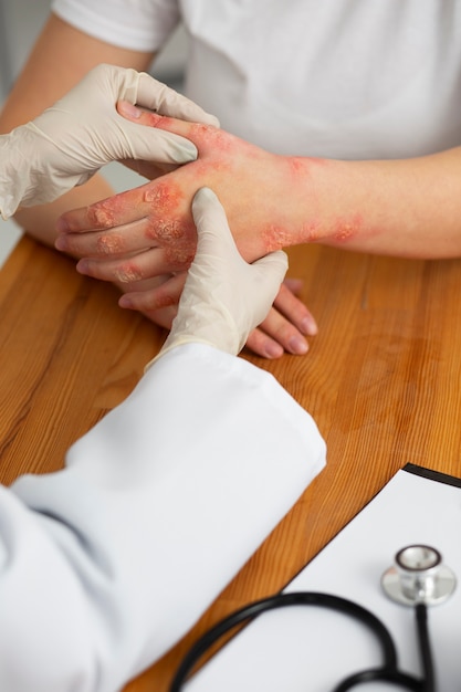 Photo mains d'un patient souffrant de psoriasis