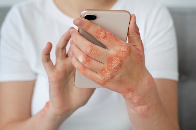 Photo mains d'un patient souffrant de psoriasis