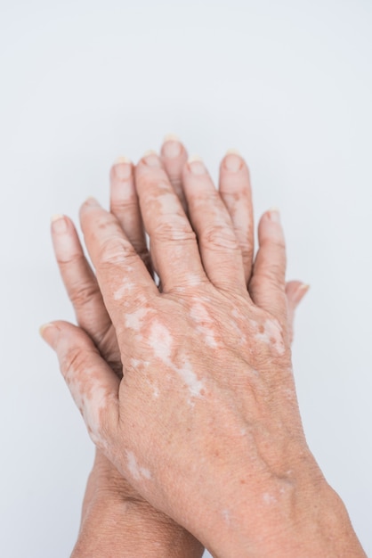 Mains avec problème de peau vitiligo