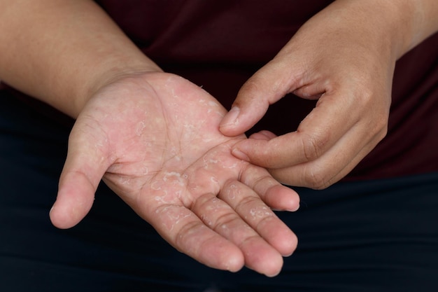 Mains sèches desquamation de la peau des mains et des doigts Allergie à l'air Allergie chimiqueDermatite EczemaxAxA