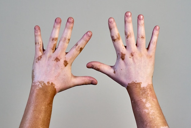 Maladie cutanée du vitiligo sur les mains des hommes